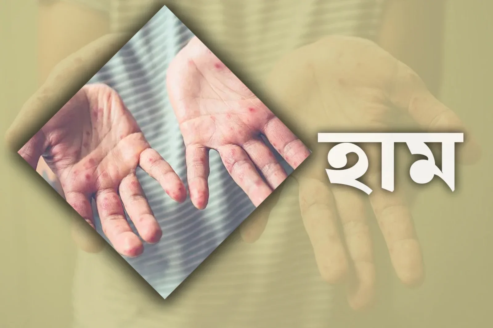 ২৪ ঘণ্টায় দেশে হাম উপসর্গে আরও ৫ শিশুর মৃত্যু