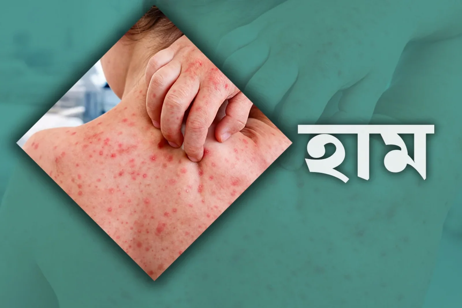 হাম উপসর্গে মৃত্যুর মিছিল থামছেই না