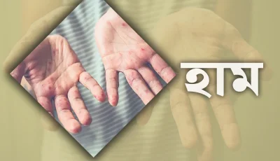 ২৪ ঘণ্টায় দেশে হাম উপসর্গে আরও ৫ শিশুর মৃত্যু
