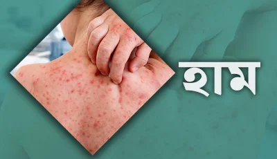 হাম উপসর্গে মৃত্যুর মিছিল থামছেই না