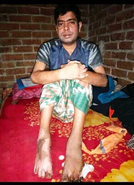 সকলের সহায়তায় বাঁচতে চাই ভোলাহাটের প্রতিবন্ধী আব্দুর রহিম